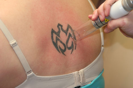Butterfly tattoos removal Once you and your doctor have agreed on a 